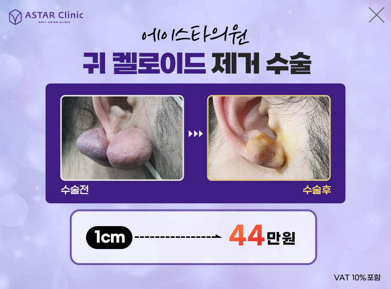 귀 켈로이드제거